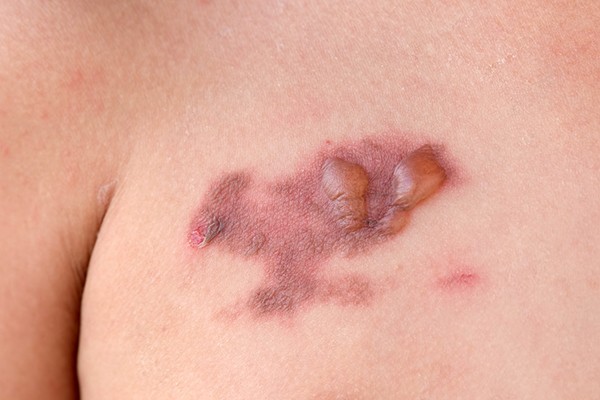 Puntos negros o bultos rojos en la piel: síntomas podrían anunciarle una enfermedad rara
