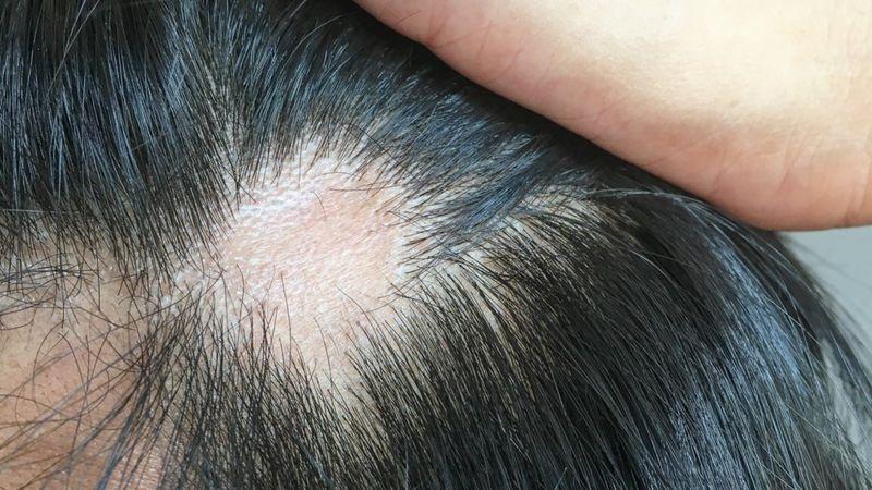Coronavirus: qué causa y cómo tratar la caída del cabello que afecta a uno de cada 4 infectados