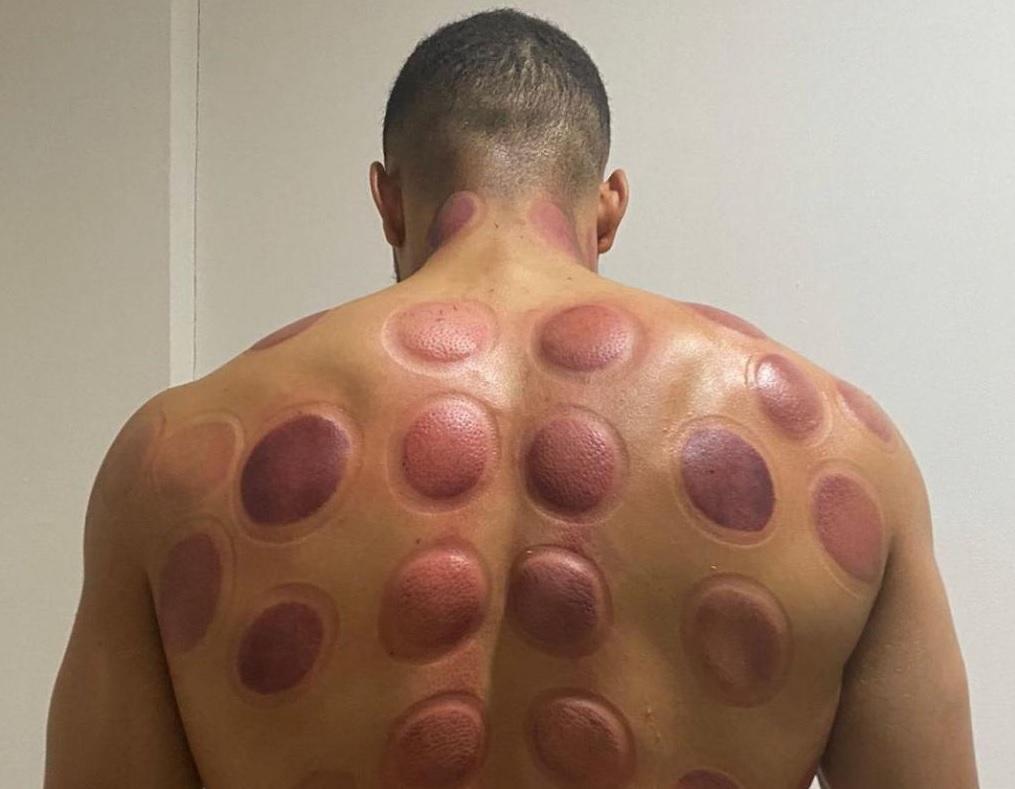 Así luce la espalda de este futbolista… conozca el singular método de recuperación que usan los famosos
