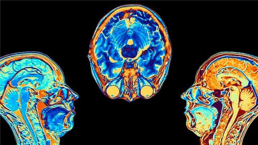 Covid-19: el estudio que muestra cómo cambia el cerebro tras una infección, aunque sea leve