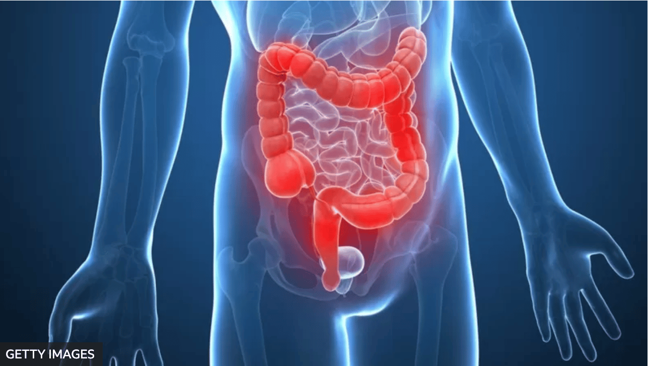 Cáncer de colon: cómo reconocer sus síntomas a tiempo (y por qué se deben revisar las heces)