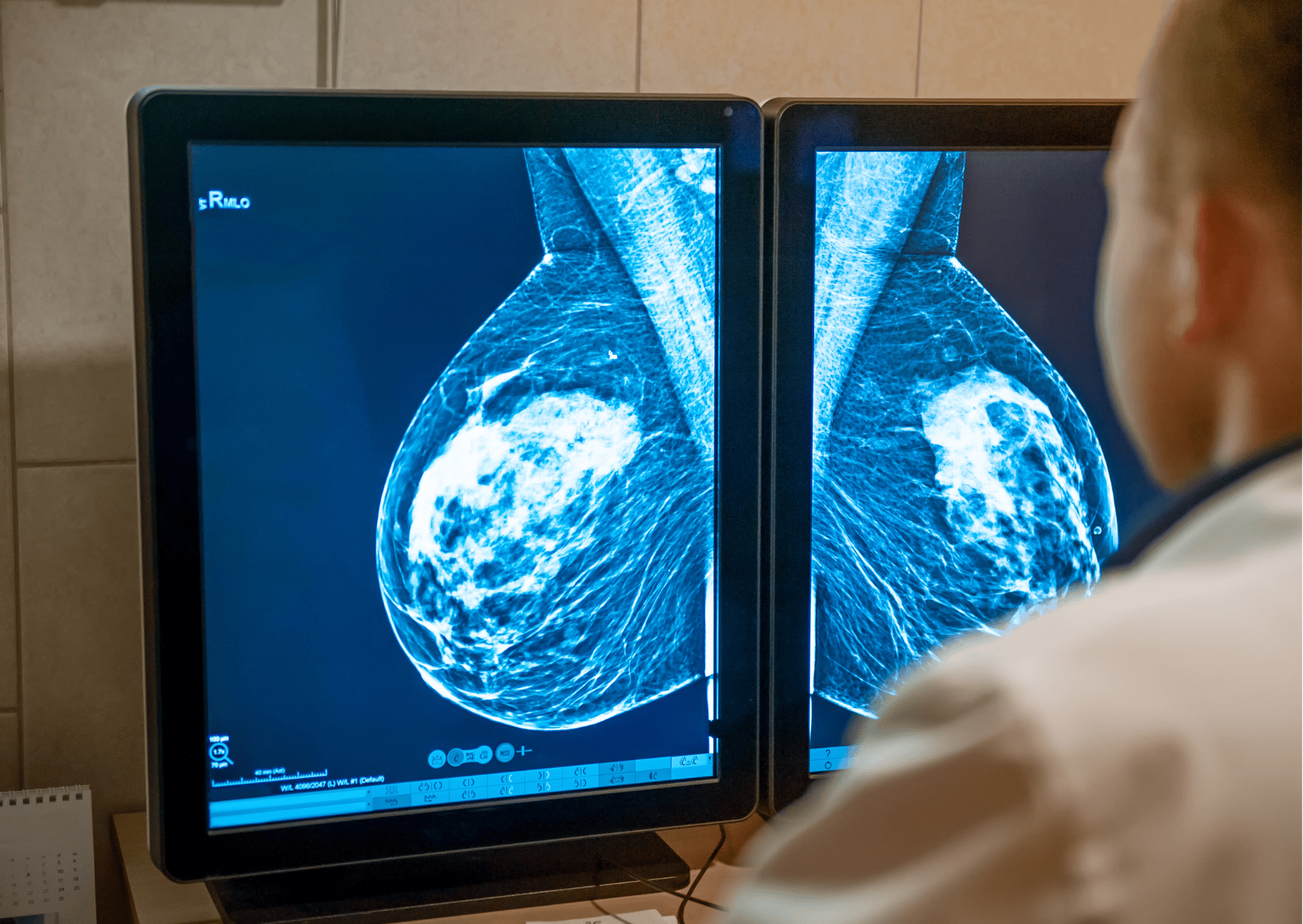 San José, Alajuela y Heredia son las provincias con mayor incidencia de cáncer de mama