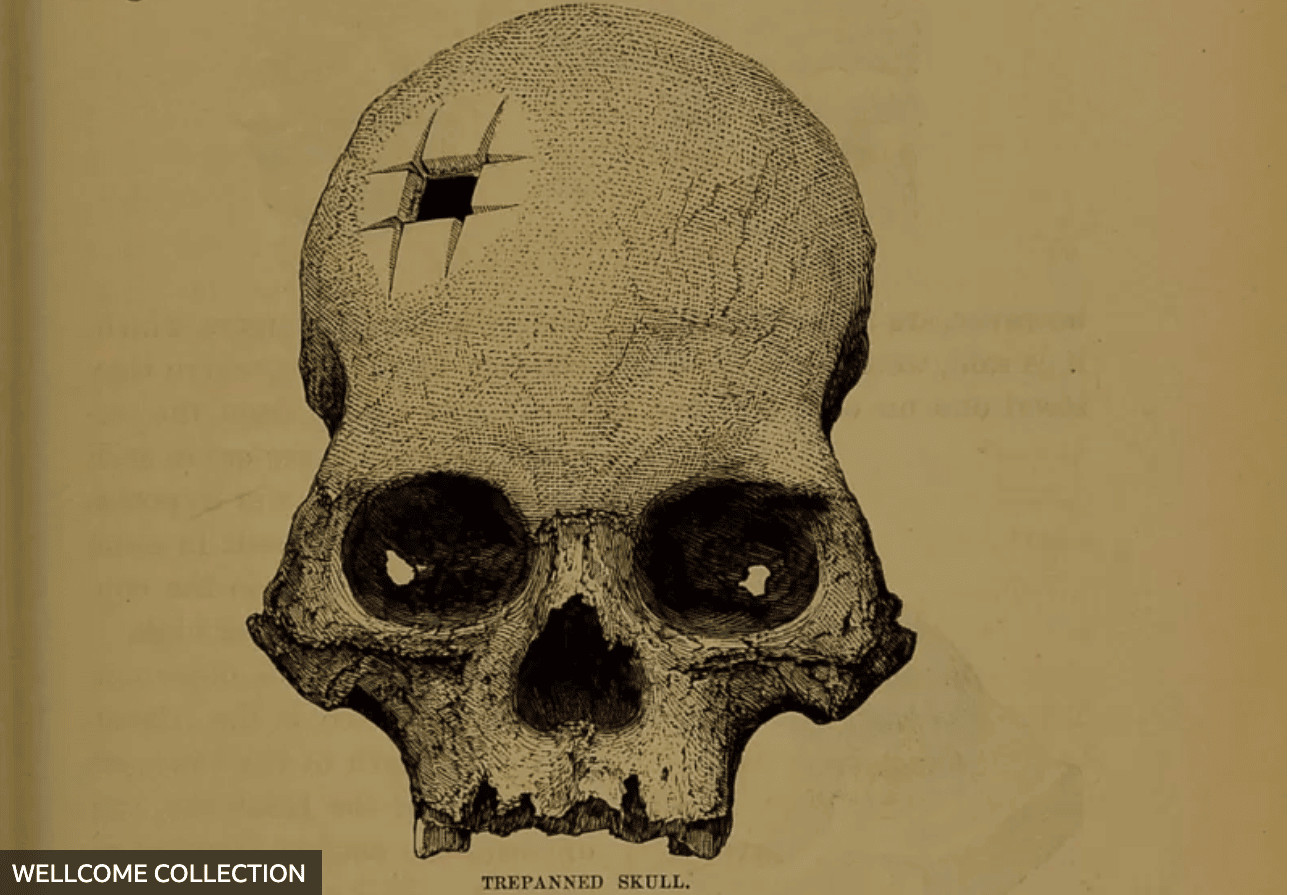 El cráneo con un agujero perfecto que confirmó que los incas realizaban con éxito complejas cirugías