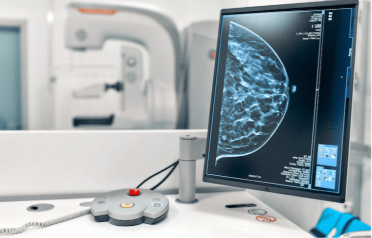 Costa Rica carece de datos actualizados por cáncer de seno: mamografía anual después de los 40 le puede salvar la vida