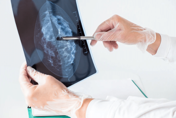 8.600 reportes de mamografías están pendientes, CCSS estima que finalicen en febrero