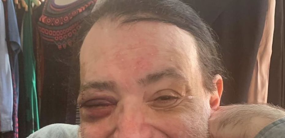 Artista Carlos Tapia recibió golpiza en la cara durante asalto