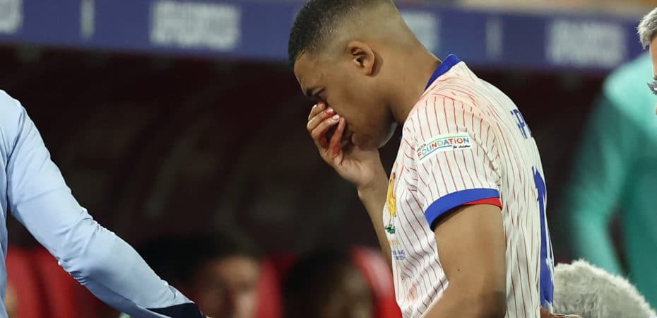Fotos | Jugador de Francia Kylian Mbappé sufre una fractura en la nariz